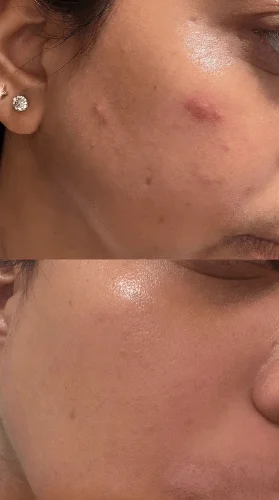 Azelaic Acid 10 Hyaluron Redness Soothing Serum